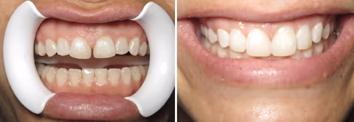 Before and after photo showing chipped front tooth repaired with composite bonding