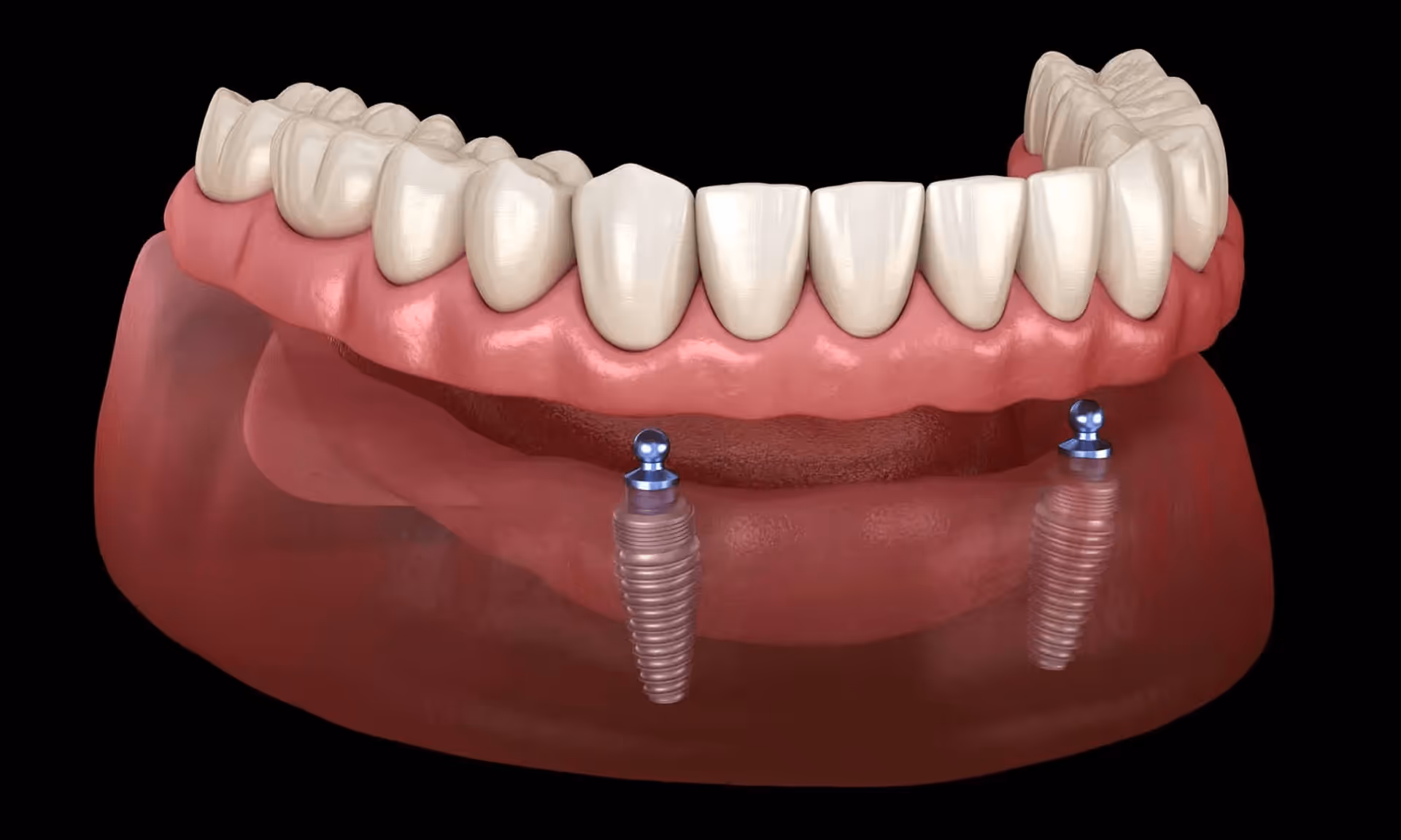 Diagram showing dental implants with locator attachments supporting lower denture