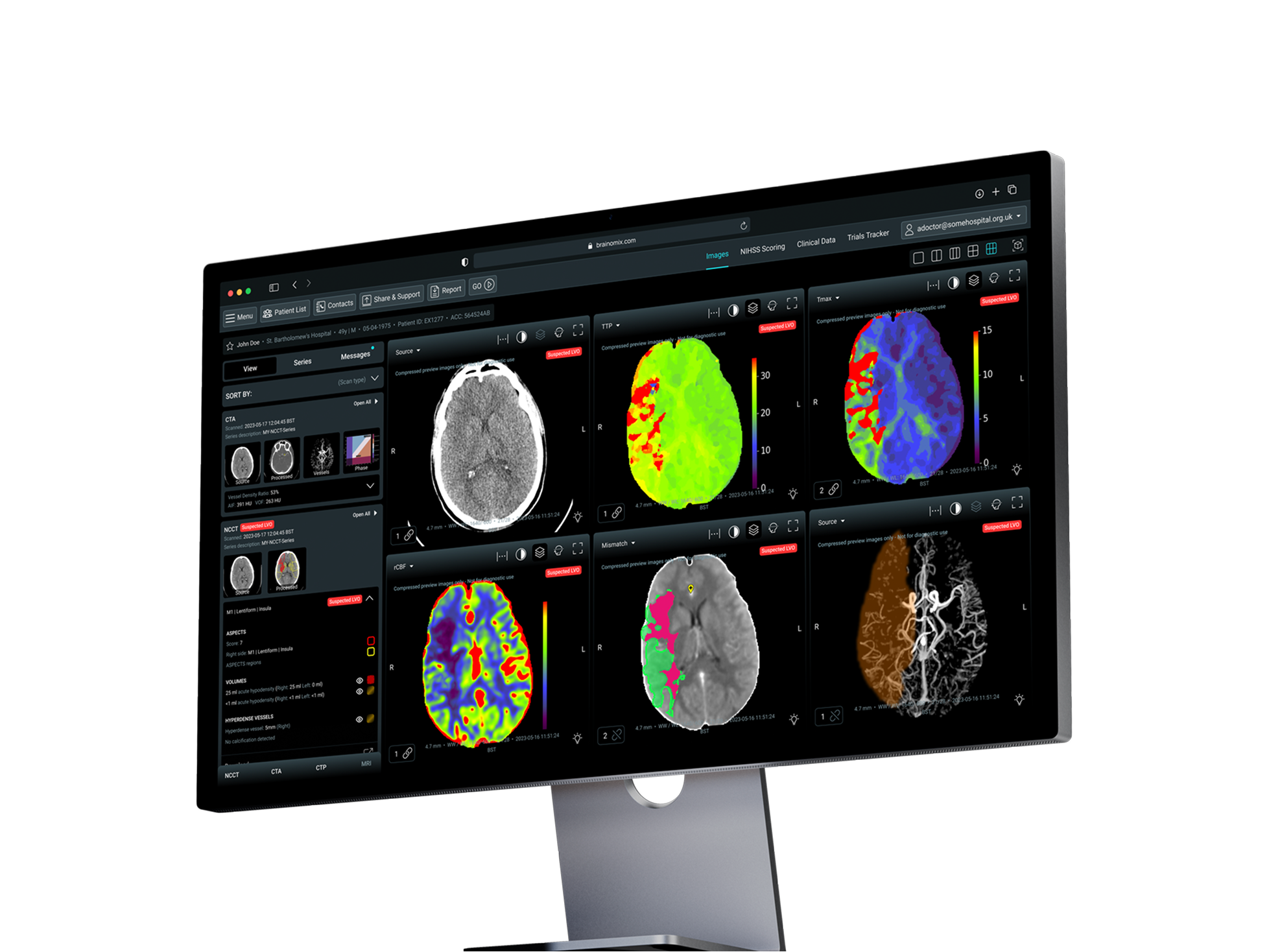 Computer monitor displaying detailed brain scan images with color-coded diagnostic data and stroke analysis.
