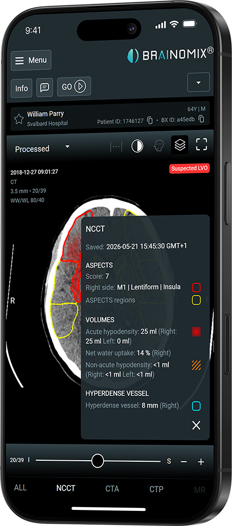 Smartphone showing Brainomix app with brain CT scan highlighting ischemic stroke regions and volumetric data.