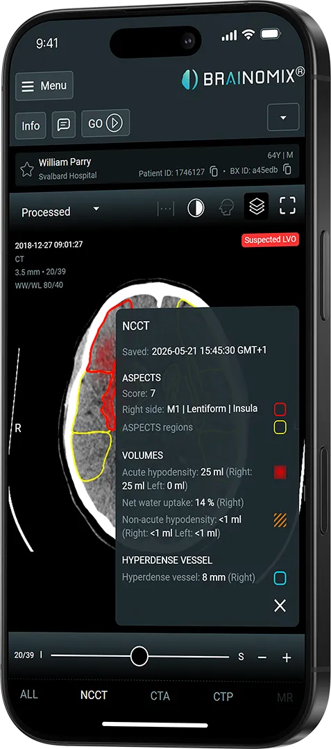 Smartphone showing Brainomix app with brain CT scan highlighting ischemic stroke regions and volumetric data.