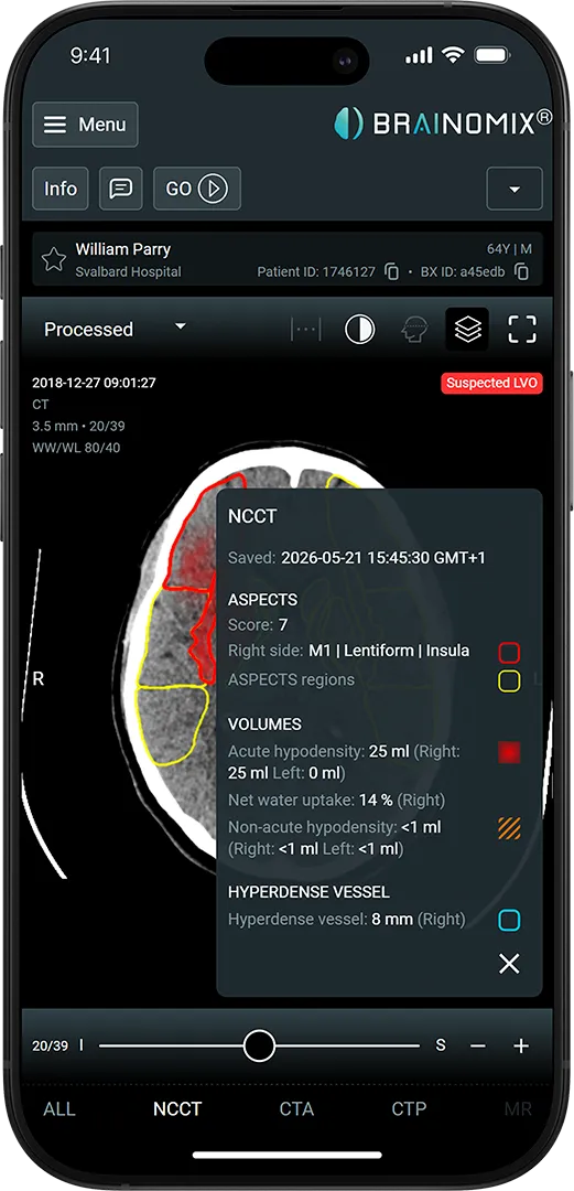 Brain CT scan on phone screen shows suspected LVO stroke with ASPECTS score 7 and volume measurements.