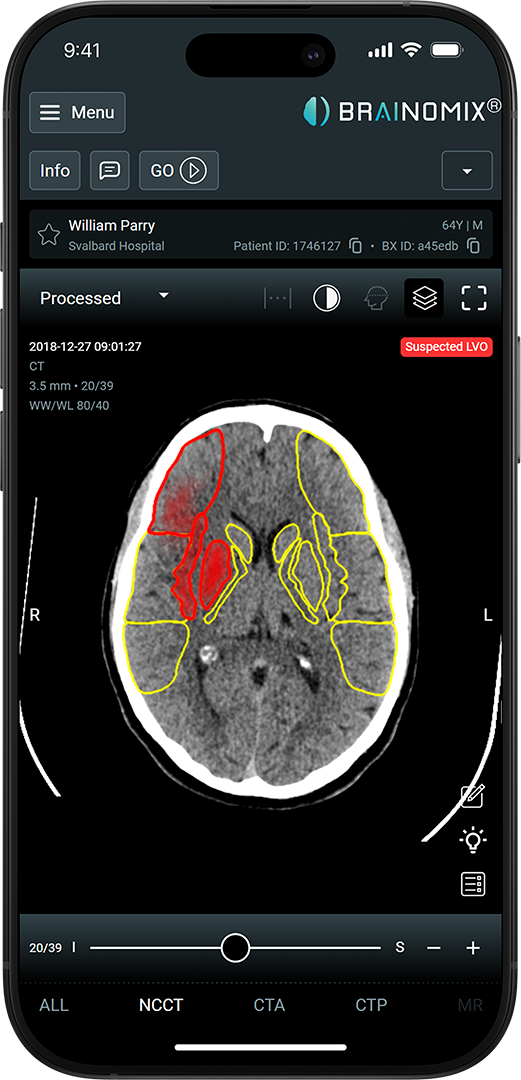 Brainomix 360 Stroke laptop interface