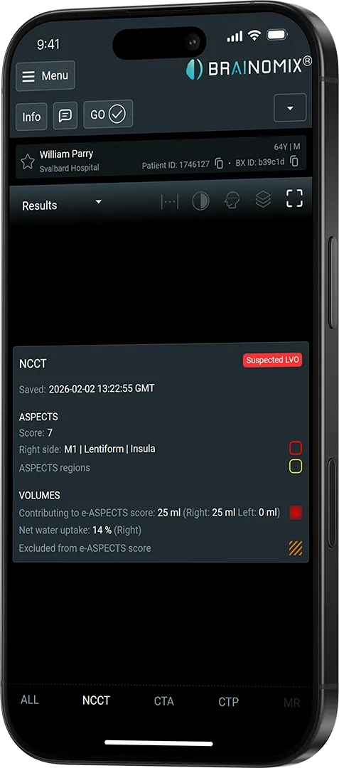 Brainomix app screen shows NCCT results for patient William Parry with ASPECTS score 7, suspected LVO, and volume data.