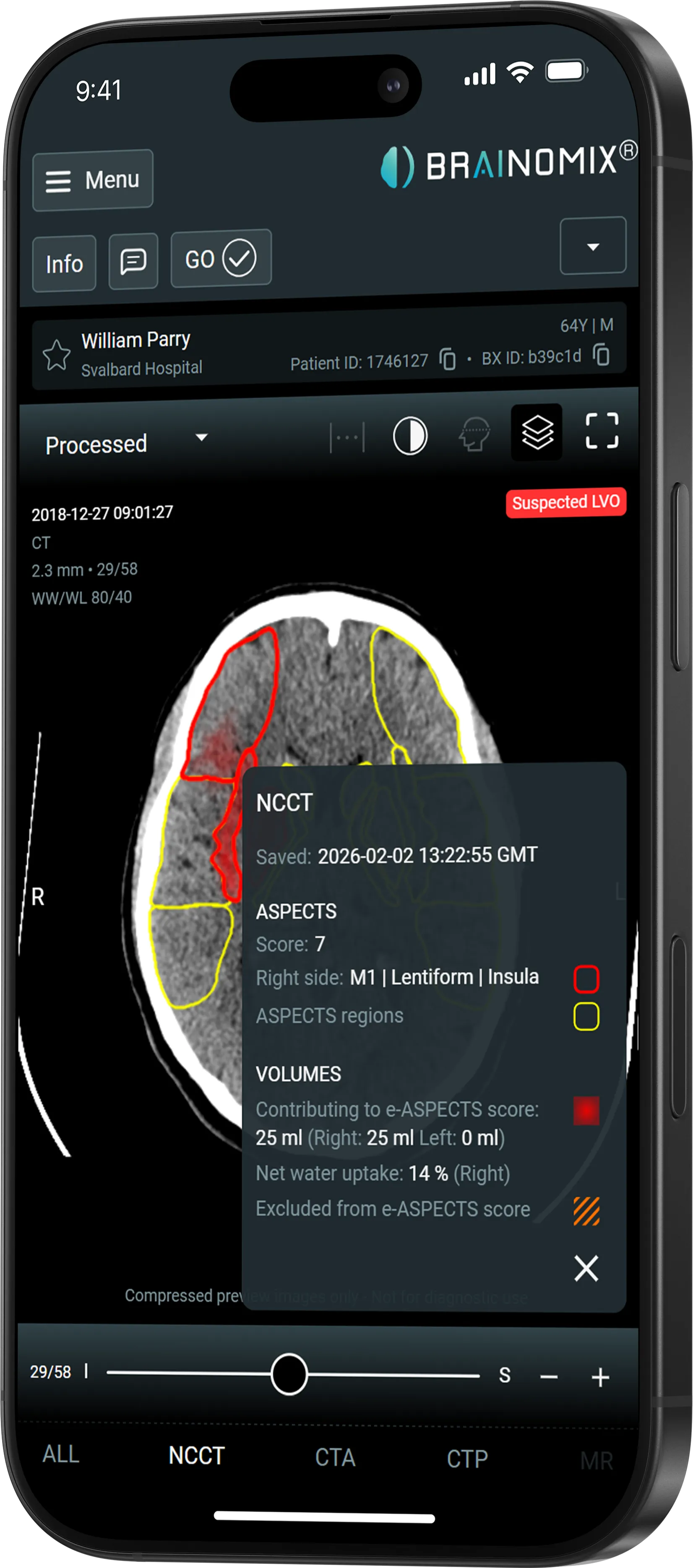Brain CT scan on phone showing ASPECTS score 7 with red-highlighted affected regions and volume details.