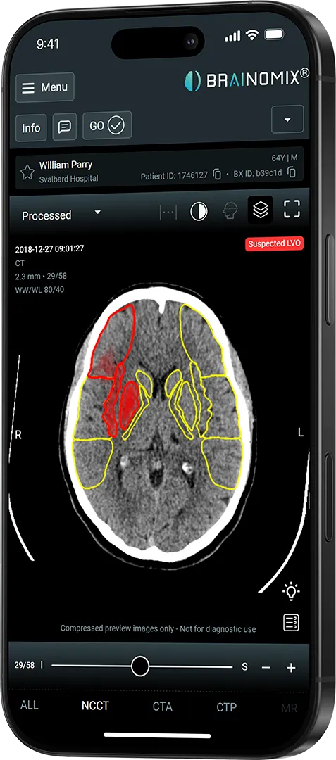 Mobile screen showing brain CT scan with red and yellow outlines indicating suspected stroke areas.