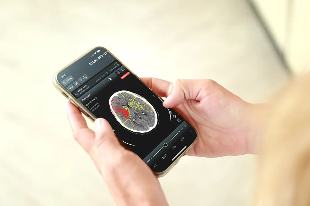 Hands holding a smartphone displaying a brain scan with red and yellow highlighted areas in a medical app.