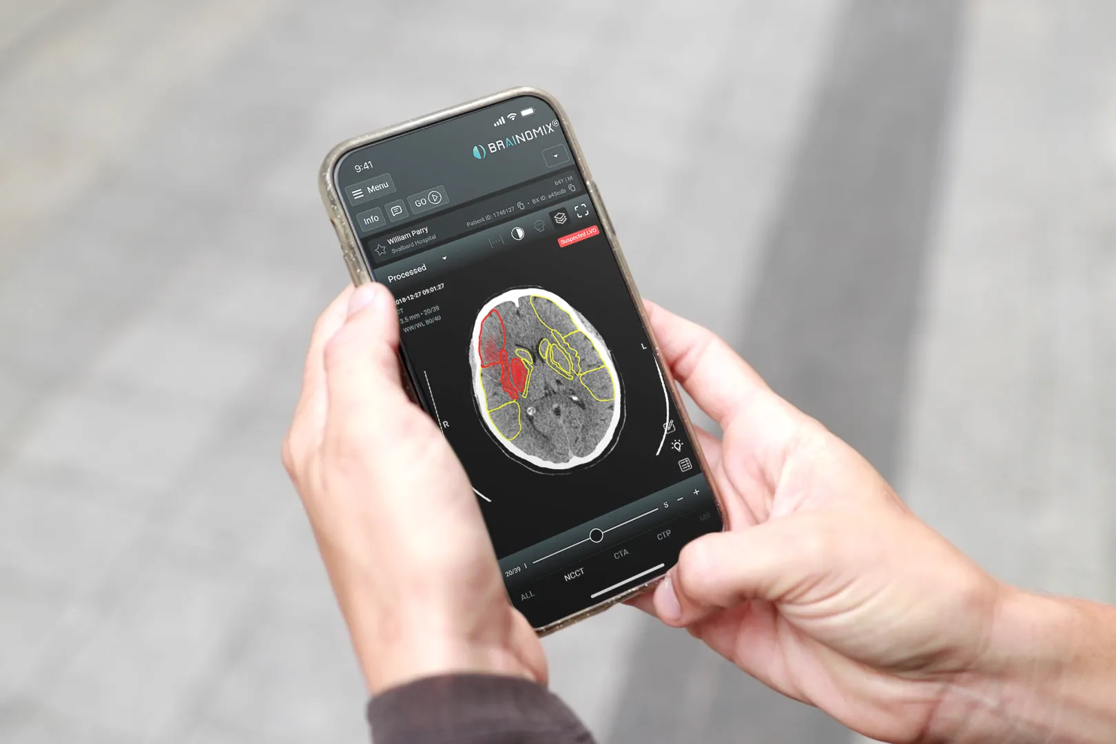 Person holding phone showing brain scan with red and yellow markings on the screen.