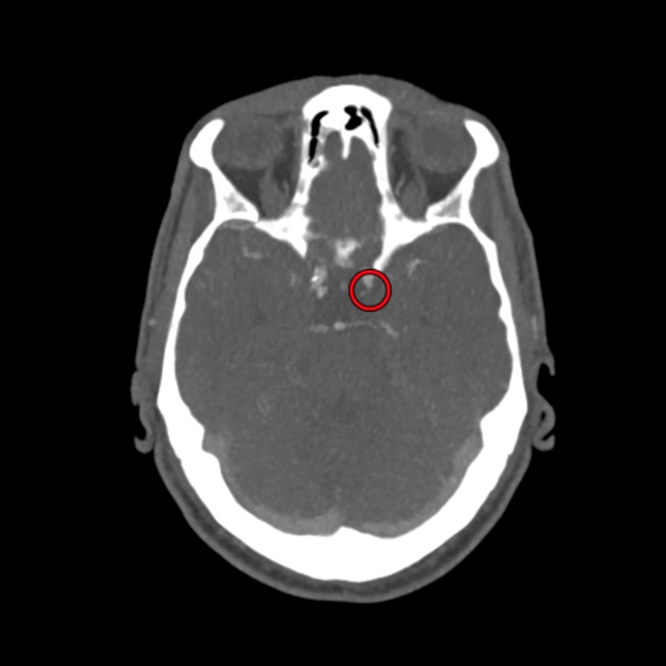 CT scan of a brain with a red circle highlighting a clot in a blood vessel near the center.