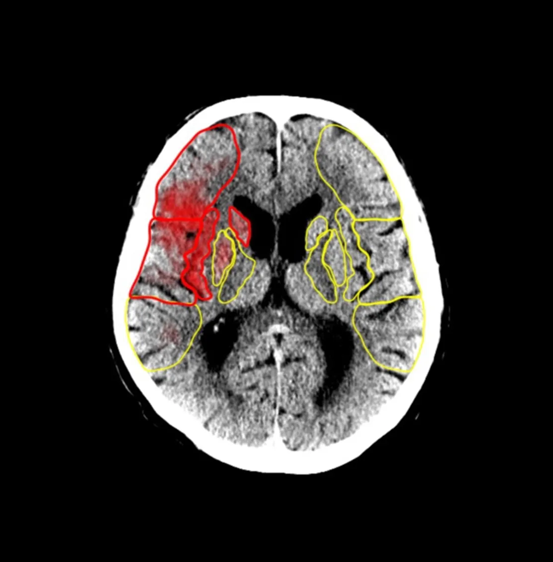 CT brain scan with red and yellow outlines highlighting areas in the left hemisphere.