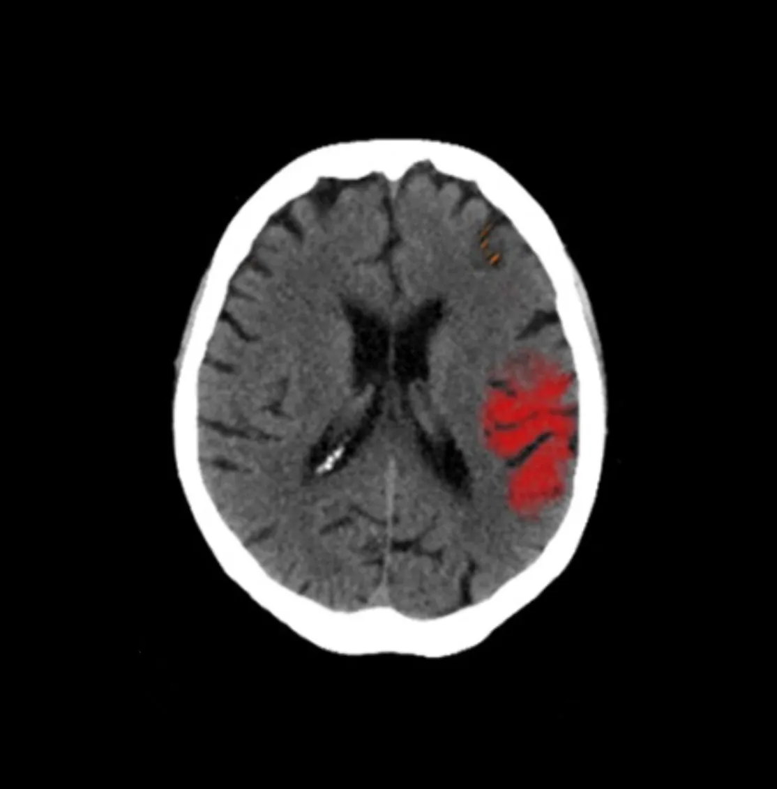 CT brain scan showing red-highlighted area on right side indicating possible abnormality or hemorrhage.