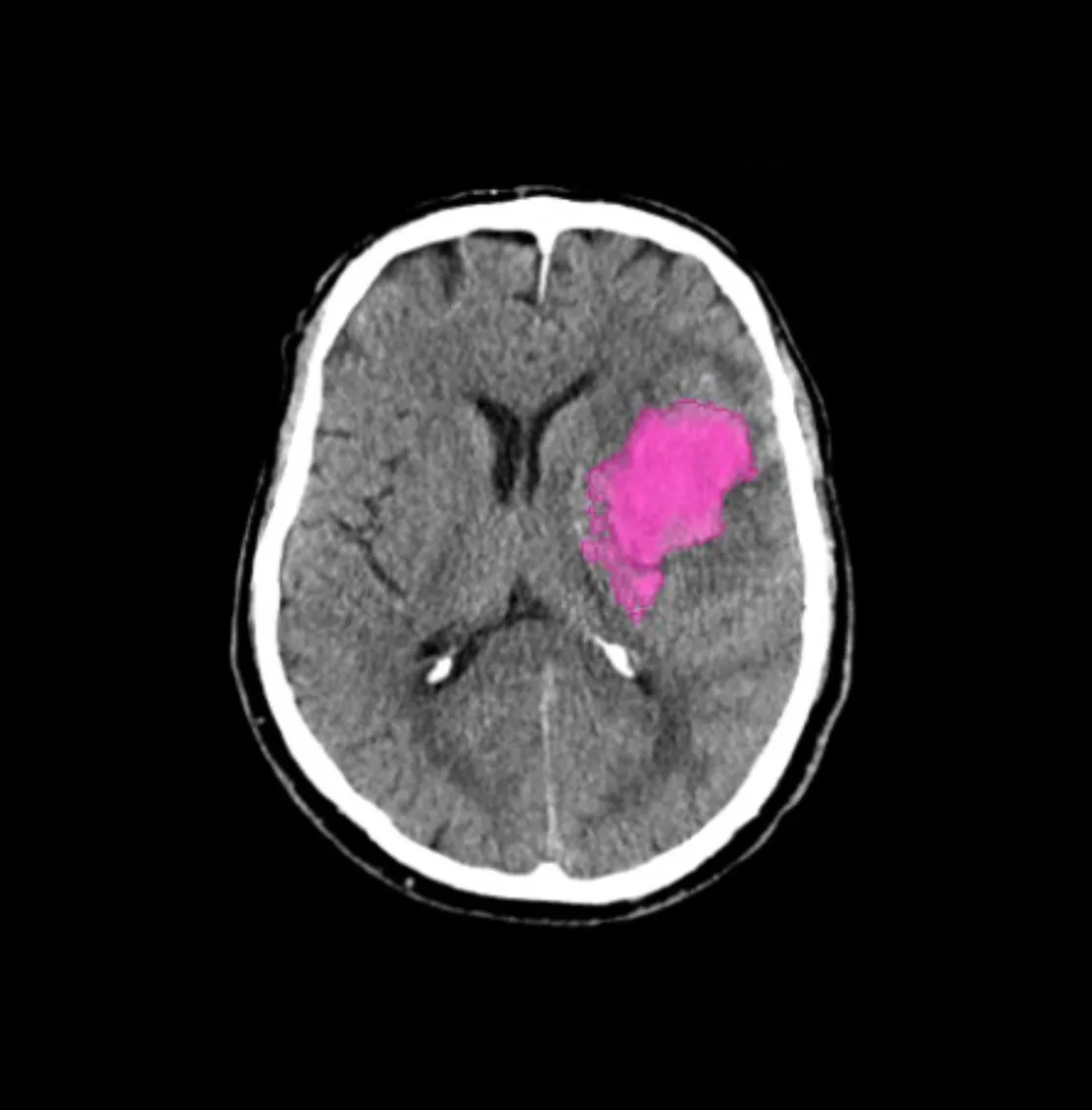 CT brain scan showing a highlighted pink abnormal area in the right hemisphere of the brain.