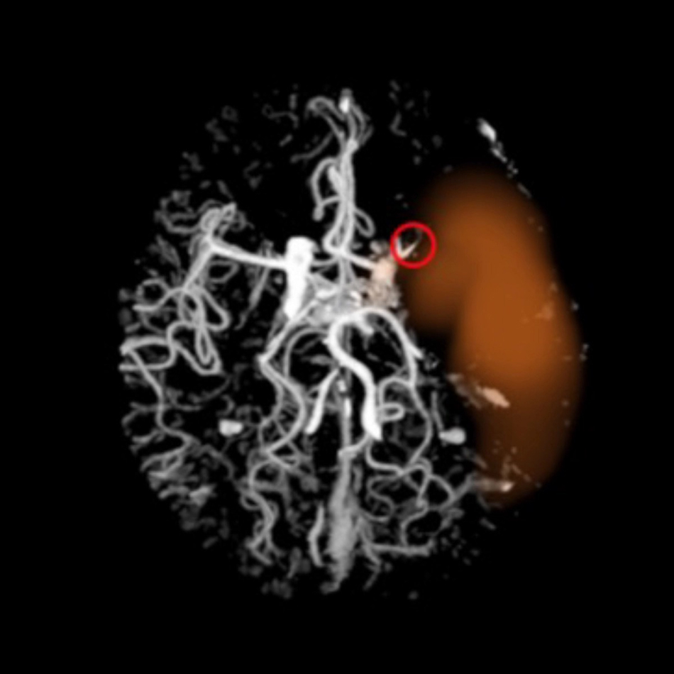 3D brain scan showing blood vessels in white with an orange highlighted area and a red circle mark.