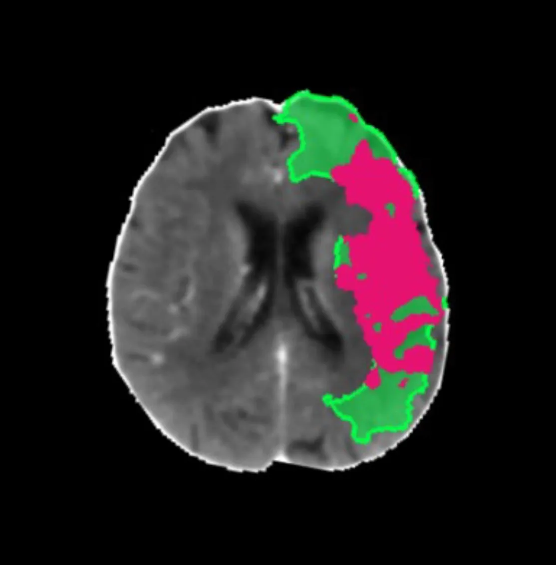 Brain scan with highlighted regions in green and magenta indicating areas of interest or abnormality.