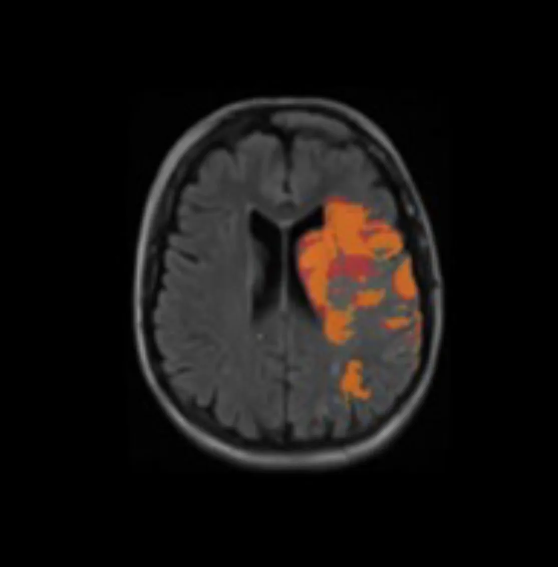 Axial brain MRI scan showing an area of orange-highlighted abnormality on the right hemisphere.