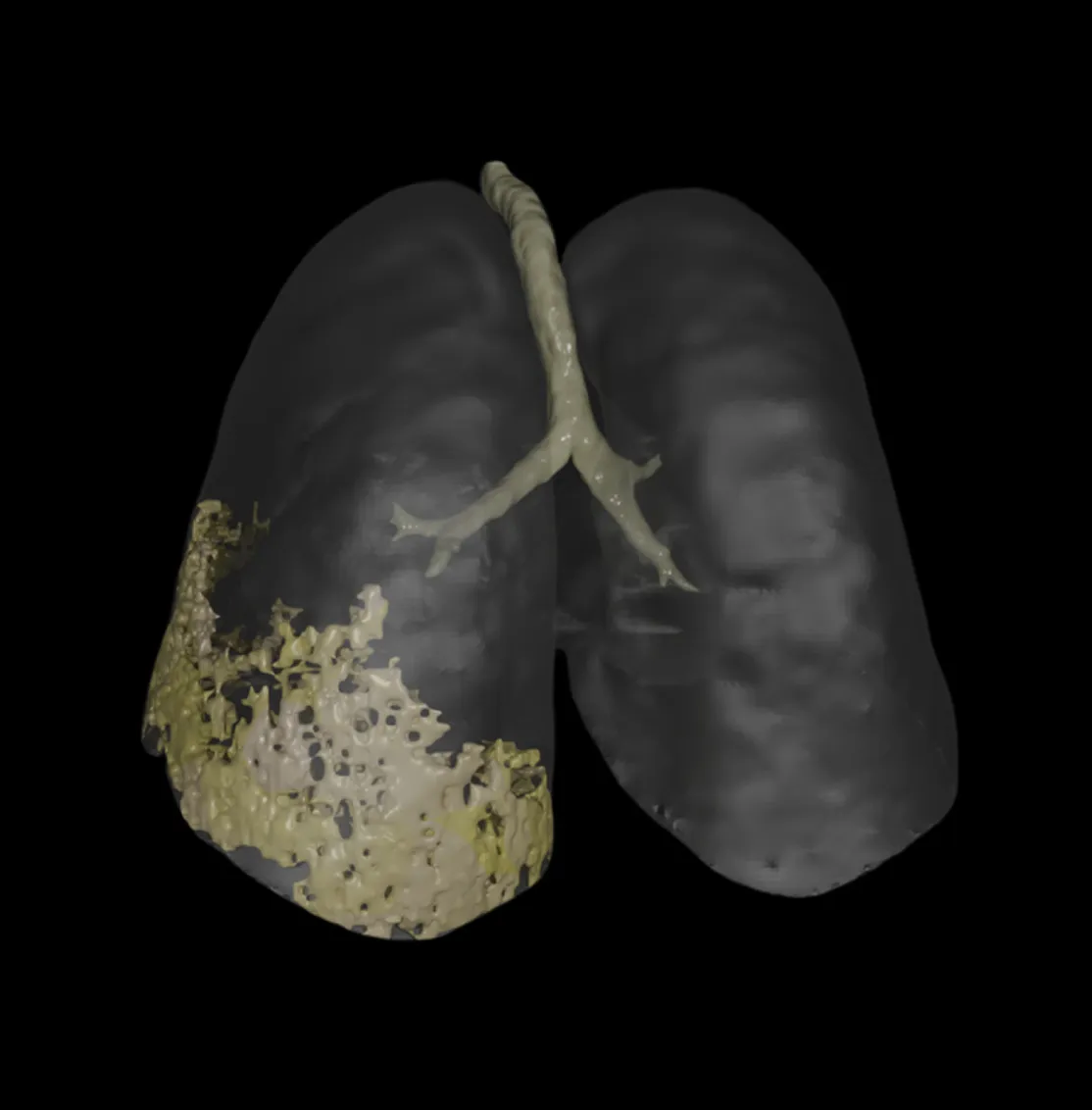 3D rendering of lungs showing bronchial tubes and damaged tissue on the lower left lung.