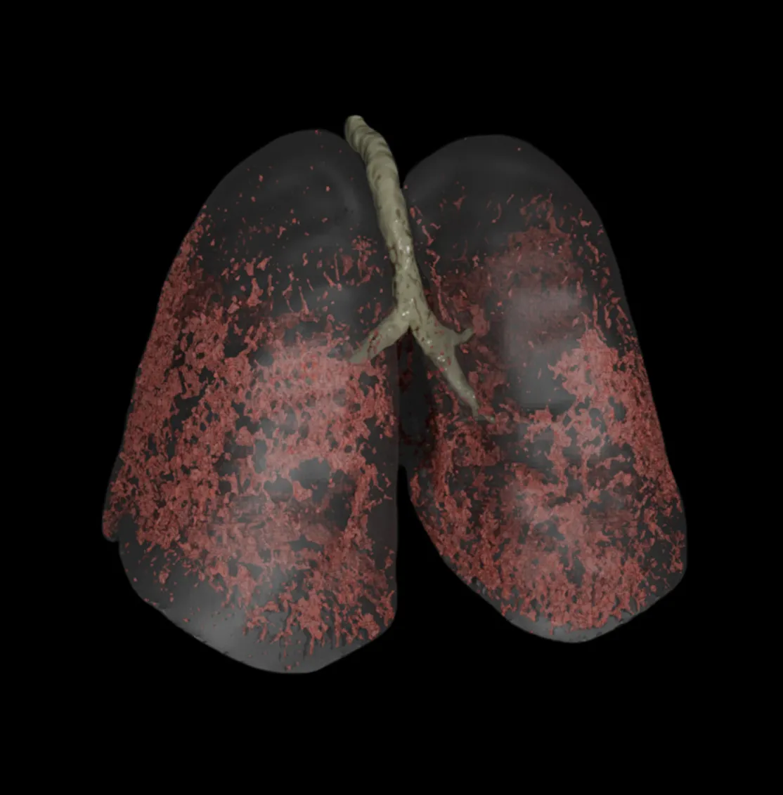 Illustration of human lungs showing widespread red patches indicating lung damage or disease.