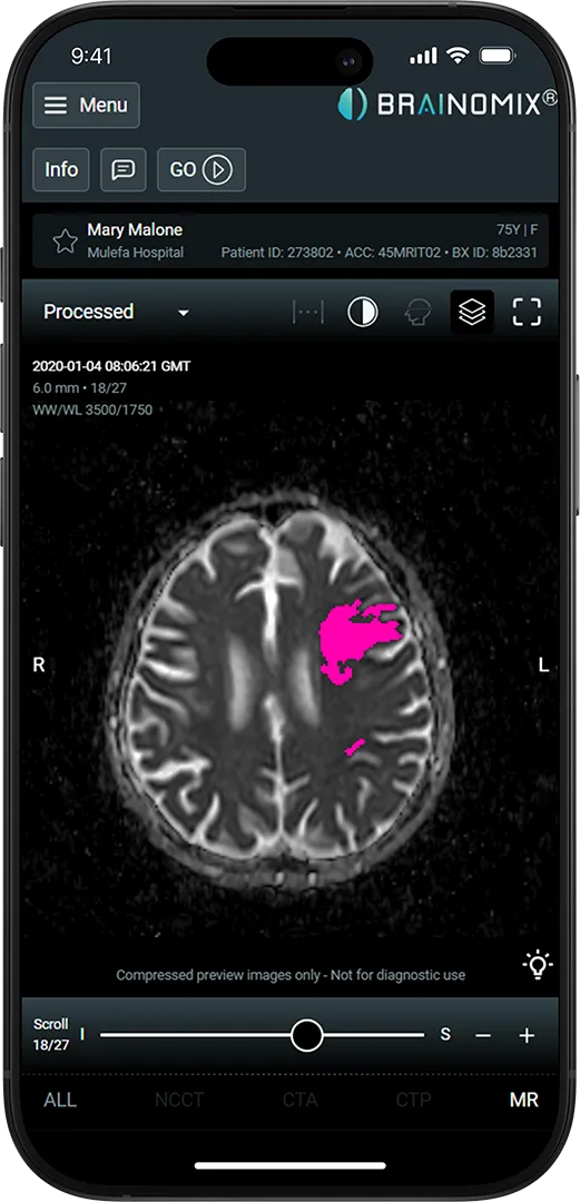 Brainomix 360 Stroke laptop interface