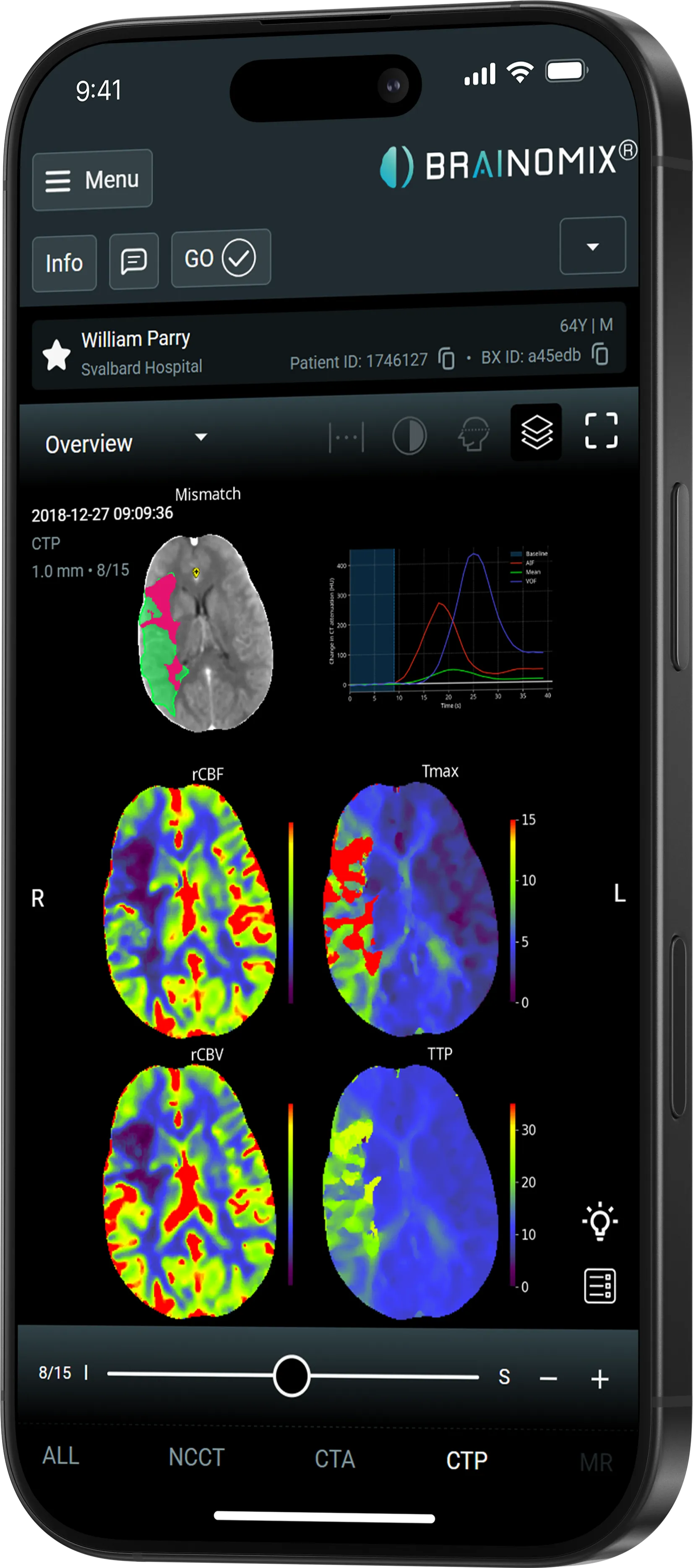 Brain imaging scans with color-coded maps and graphs showing cerebral blood flow, volume, and Tmax on phone screen.