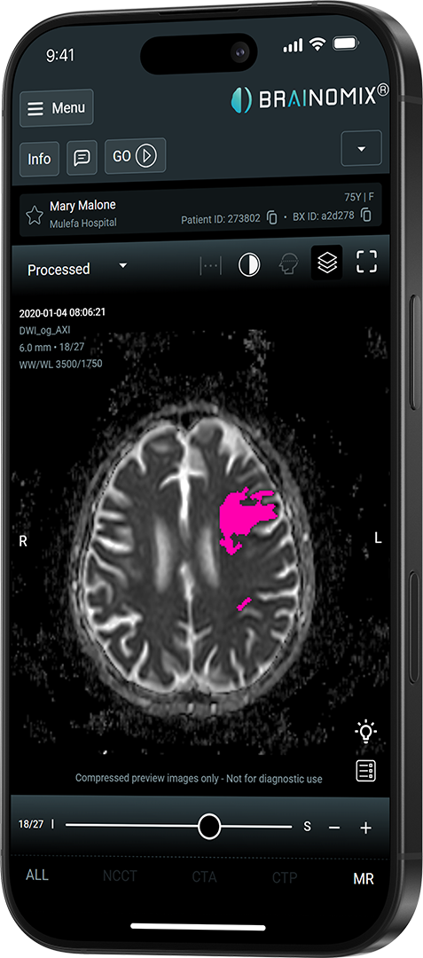 Smartphone display showing brain MRI scan with highlighted pink area indicating abnormality.
