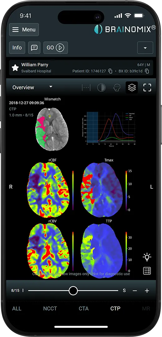 Brainomix 360 Stroke laptop interface