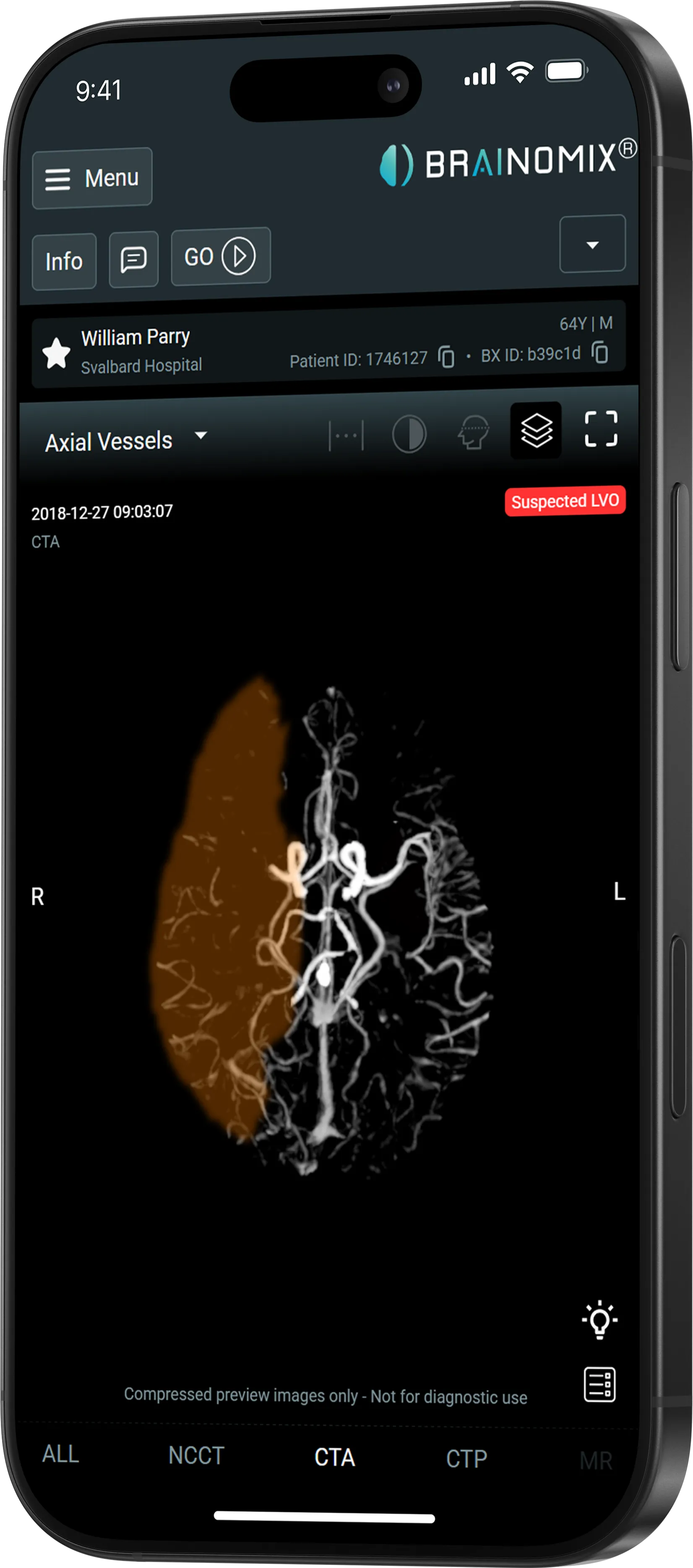 Smartphone showing brain artery scan with suspected LVO alert and partial right-side shading.