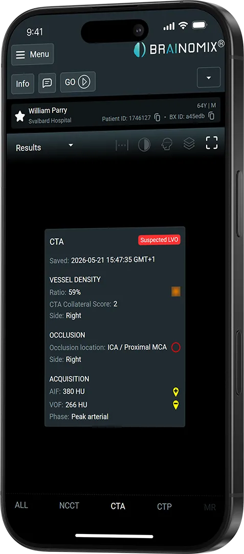 Brainomix app screen showing CTA results with vessel density 59%, right side occlusion suspected at ICA/Proximal MCA.