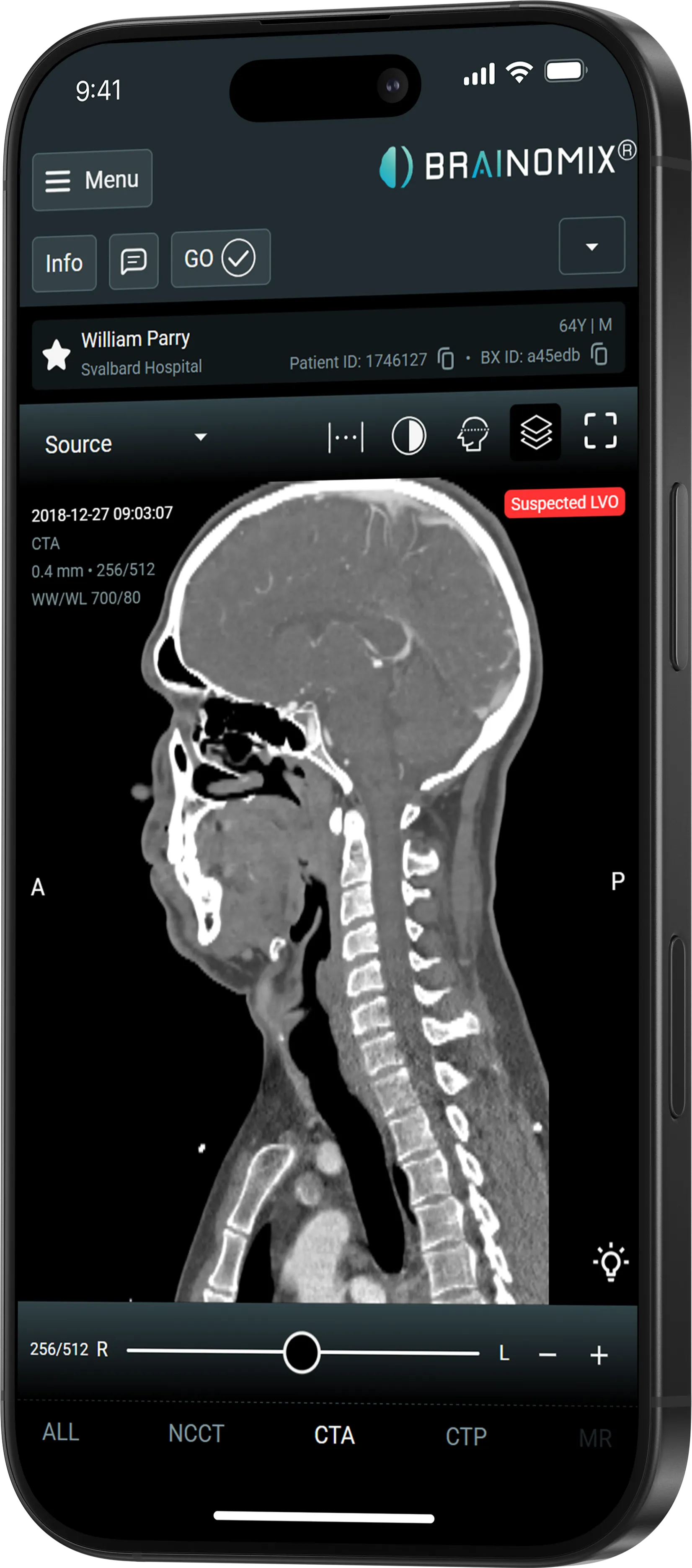 Smartphone screen showing brain and neck CTA scan with suspected LVO alert and patient details.