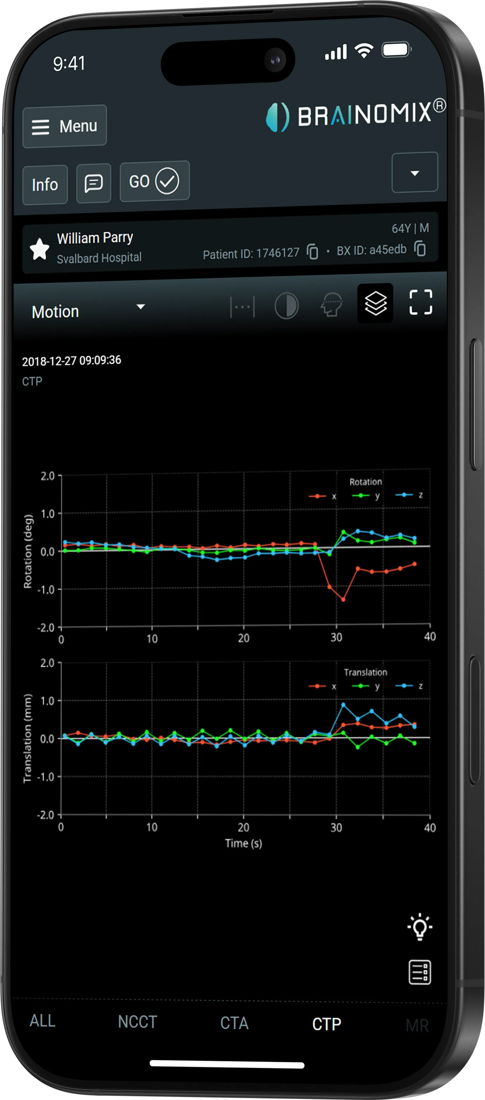 Mobile screen showing Brainomix app with patient data and motion graphs for rotation and translation over time.