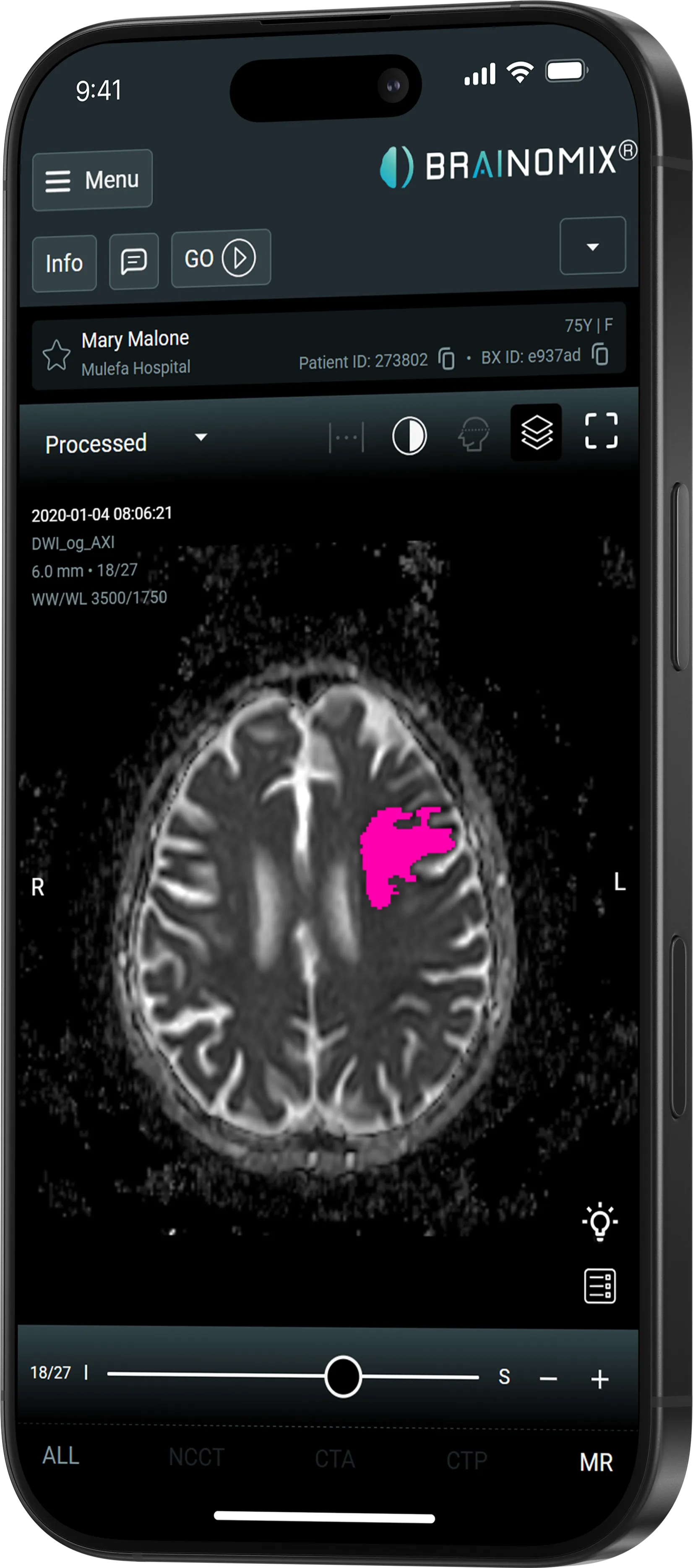 Smartphone screen showing a brain MRI scan with a highlighted pink region on the right side of the brain.