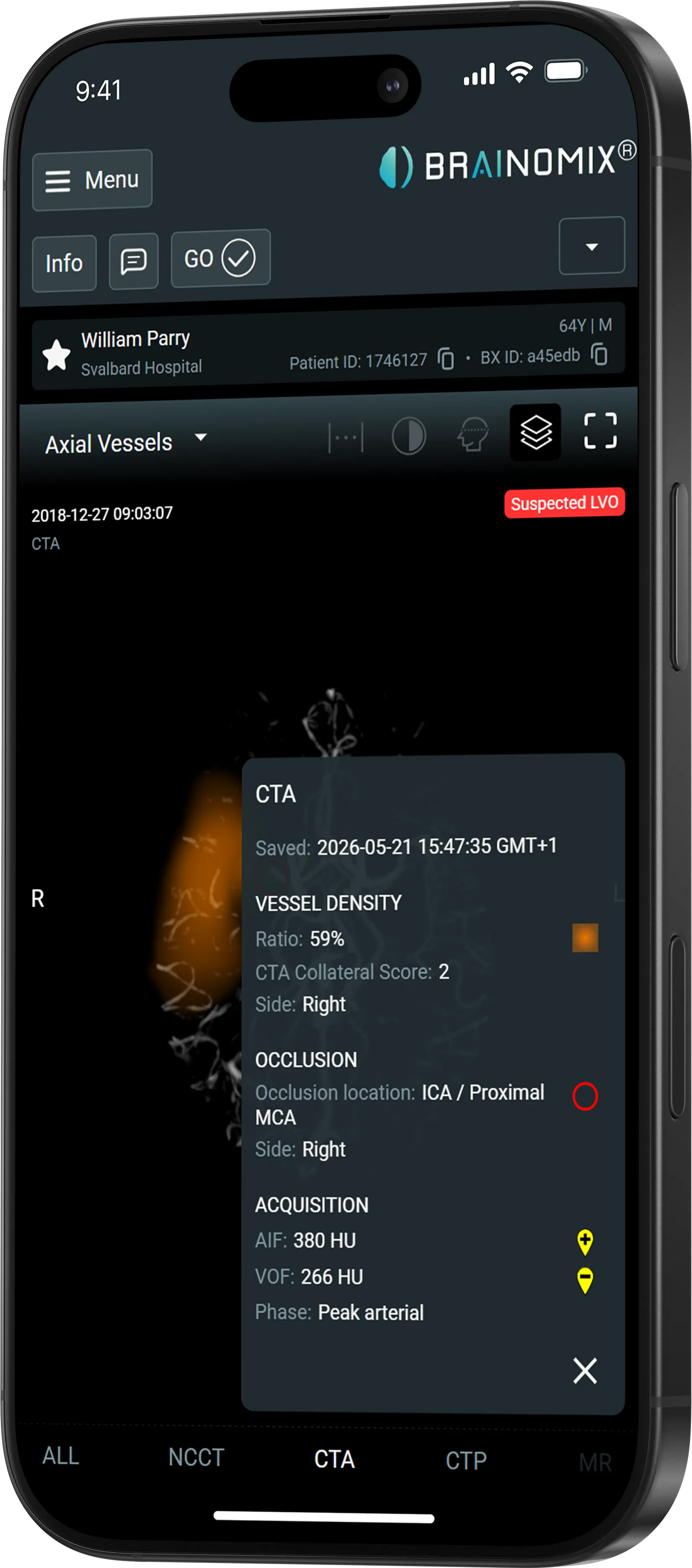 Mobile screen showing Brainomix CTA results of right MCA vessel density, occlusion, and acquisition data.