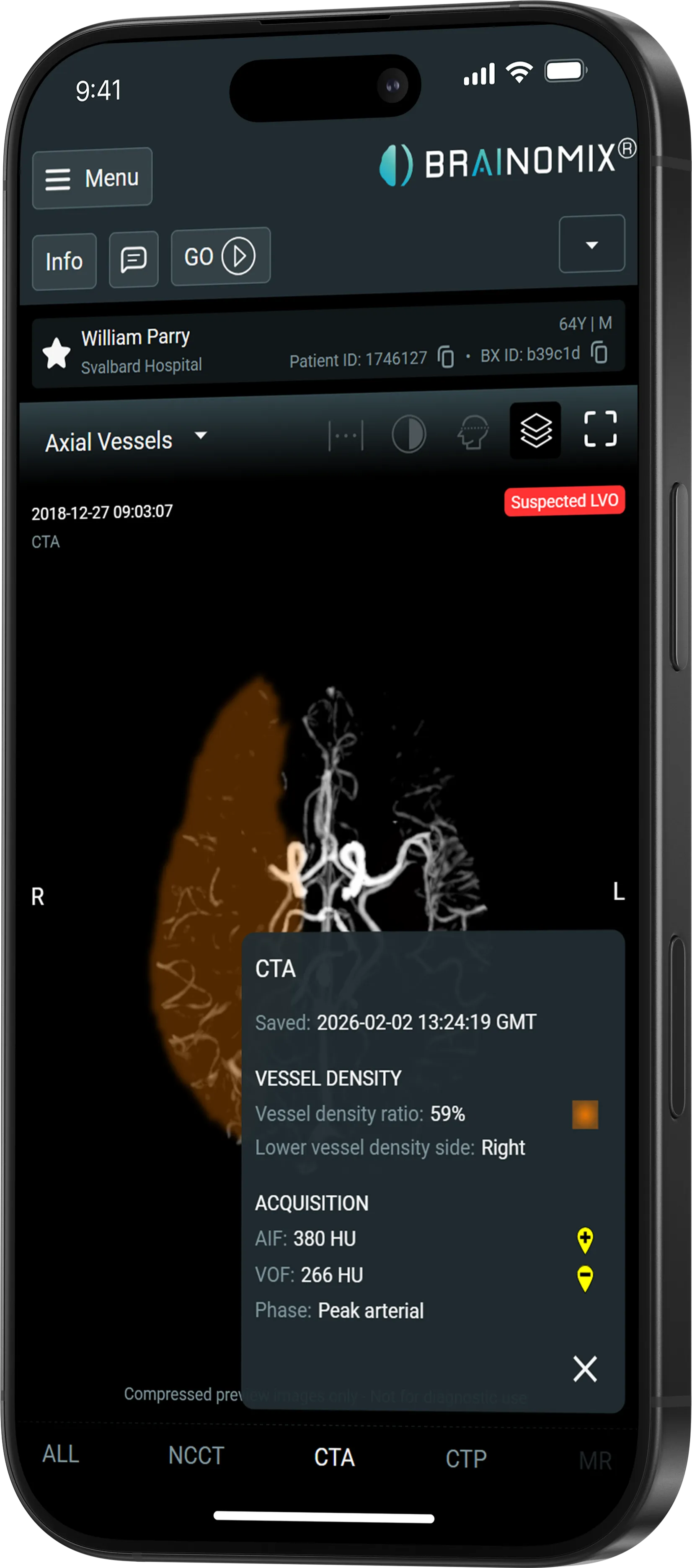 Mobile screen showing brain vessel CTA scan with vessel density ratio and acquisition details in app interface.