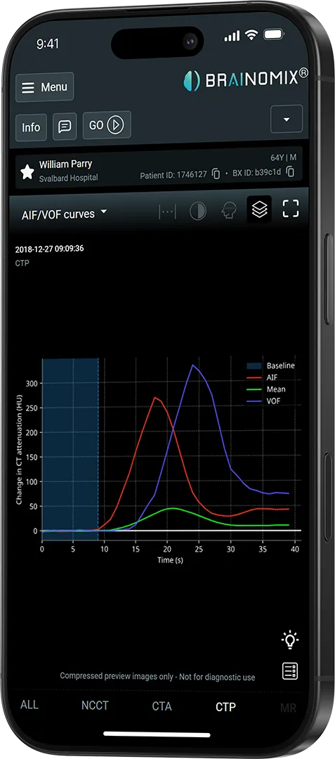 Mobile screen showing Brainomix CT perfusion graph with AIF, VOF curves, and patient info from Svalbard Hospital.