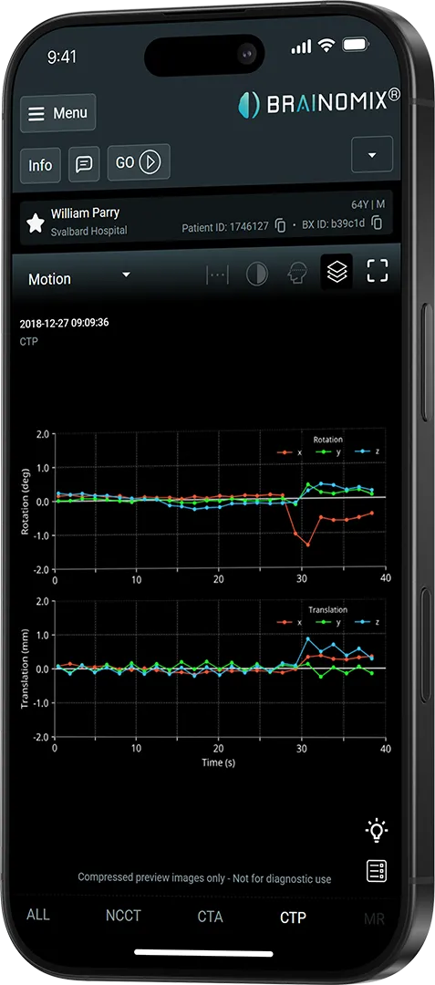 Smartphone screen showing brain imaging app with motion graphs of rotation and translation by time.