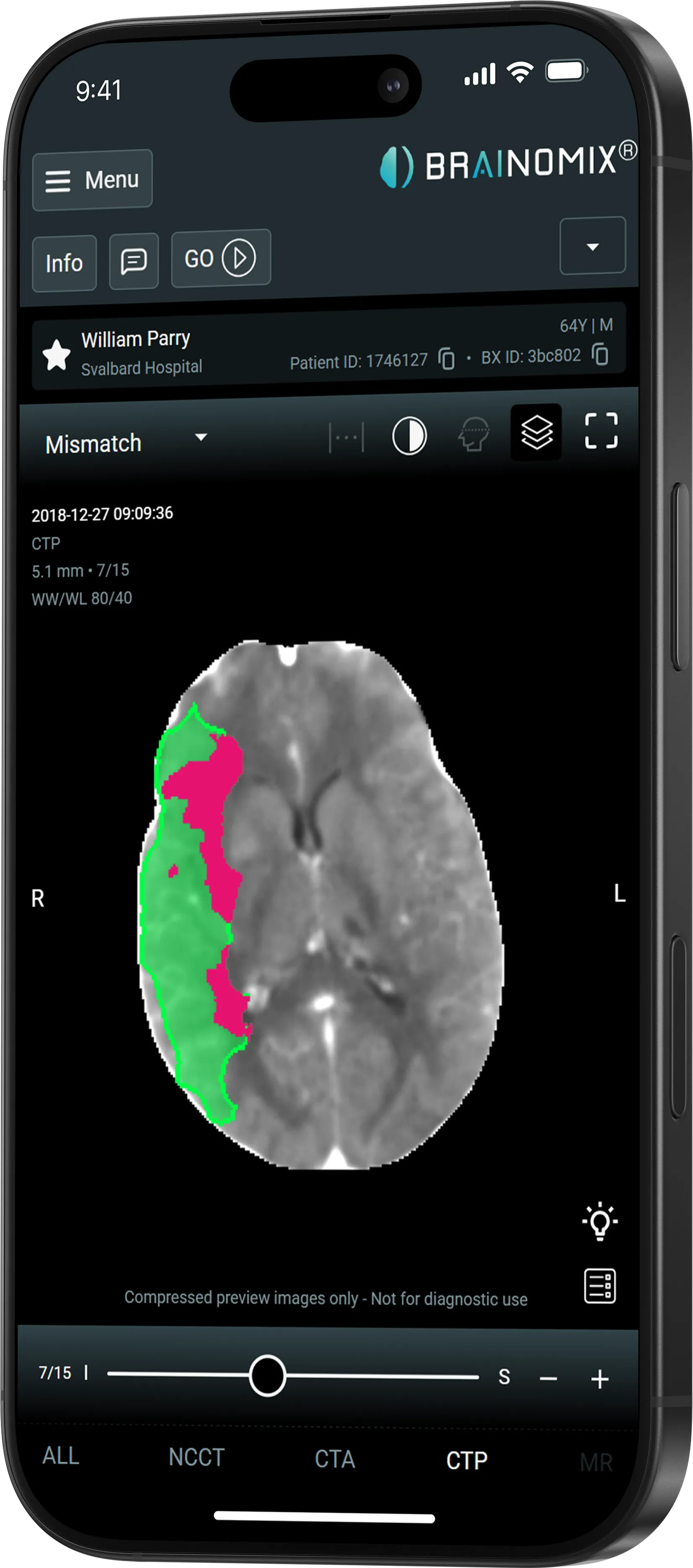 Brain CT scan on phone showing mismatch areas in green and pink on left side of brain image.