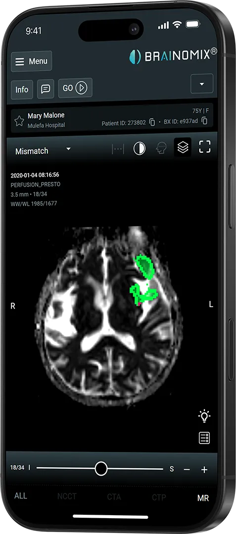 Mobile display showing brain MRI with green-highlighted mismatch areas on the right side.
