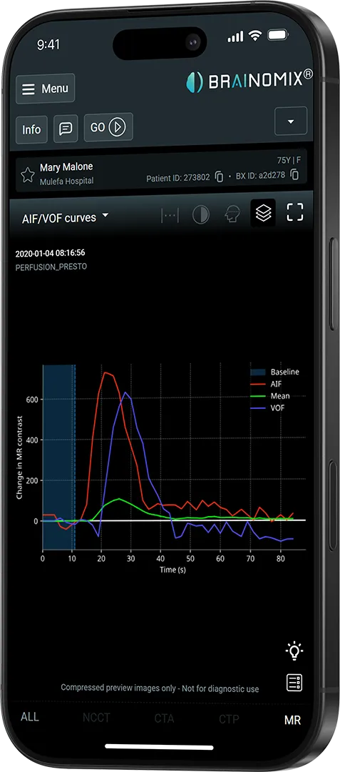 Mobile screen showing Brainomix app with AIF/VOF curves graph of MR contrast change over time for patient Mary Malone.