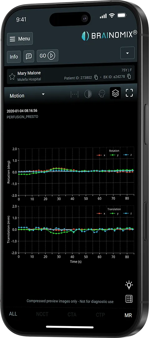 Smartphone screen showing Brainomix app with motion graphs of rotation and translation over time for a patient.