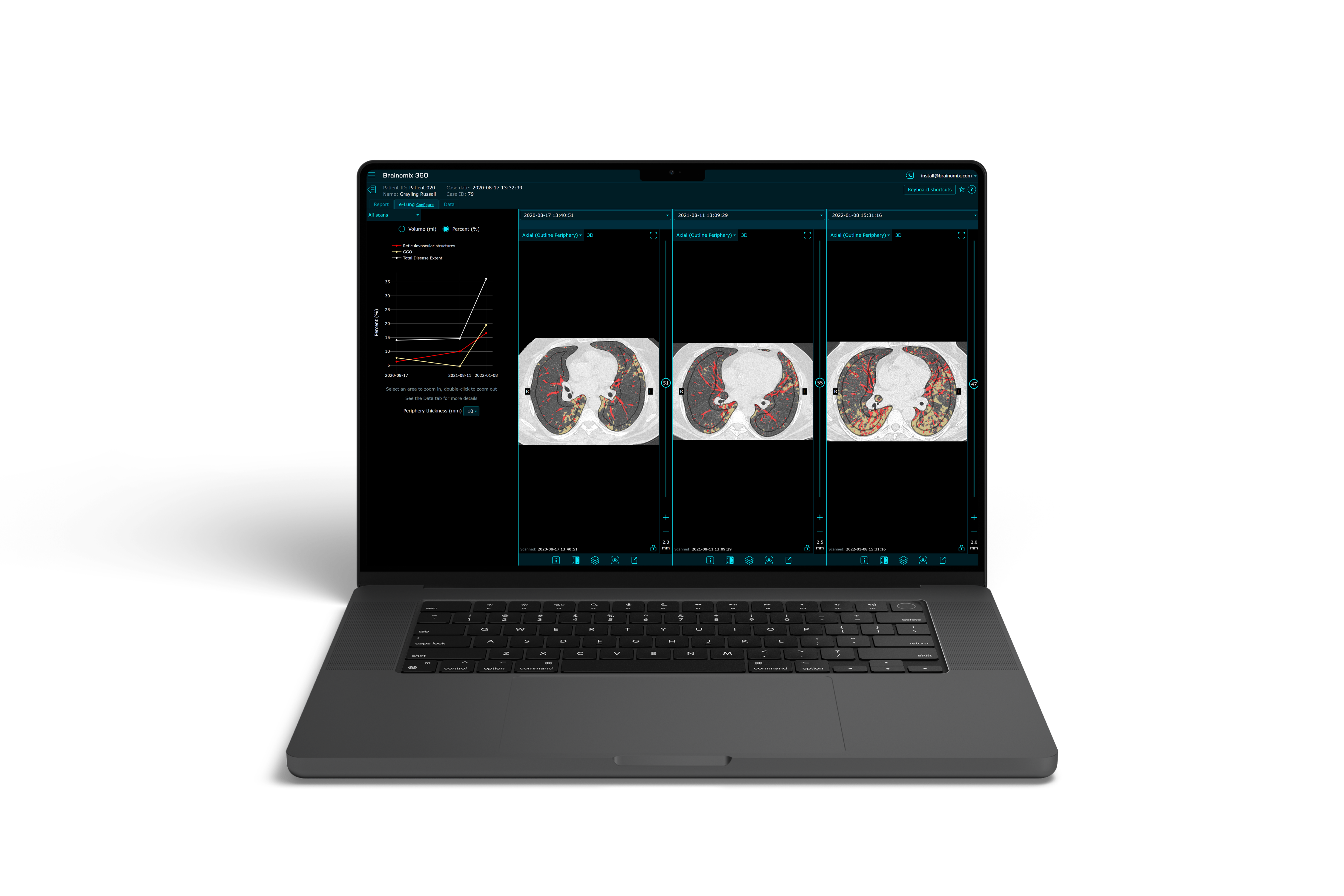 Brainomix 360 e-Lung laptop interface