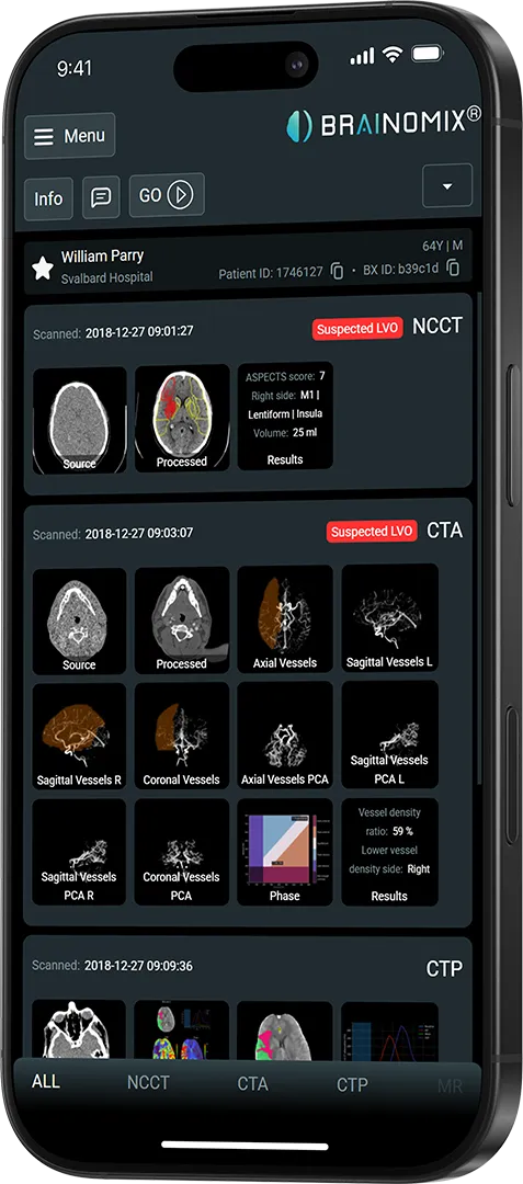 Phone screen showing Brainomix brain scan analysis with NCCT, CTA, and CTP results for patient William Parry.