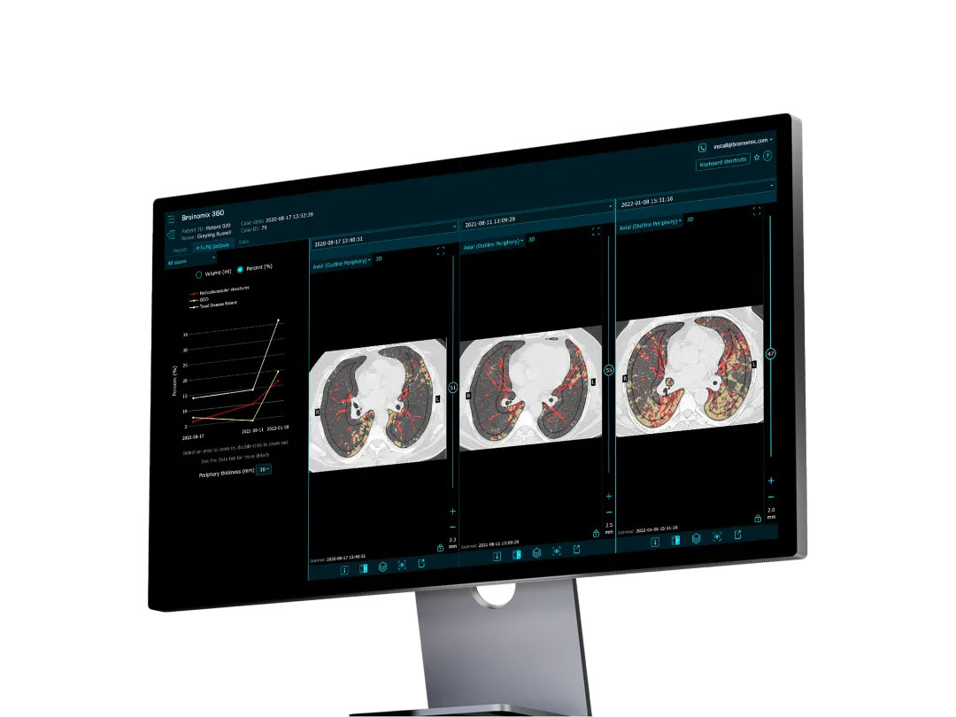 Monitor displaying lung CT scans with highlighted disease areas and a chart showing disease progression.