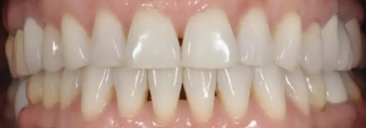 Close-up view of clean and aligned human teeth with natural gums.