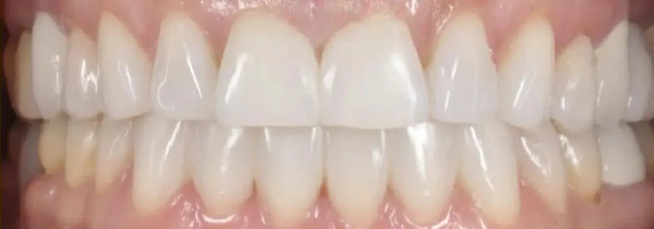 Close-up of a set of clean, aligned human teeth with visible upper and lower front teeth and gums.