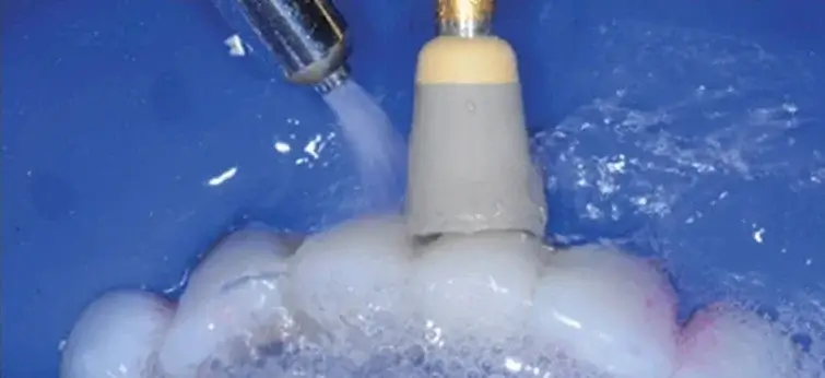 Close-up of dental scaler and polisher cleaning the surface of teeth with water spray.