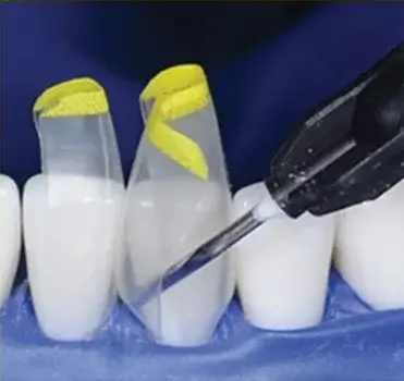 Dental procedure applying adhesive to a tooth using a dental instrument, with teeth isolated by a blue rubber dam and yellow tape.