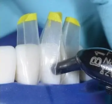 Close-up of dental bonding procedure with composite resin applied on three teeth using transparent molds and a dental curing light.