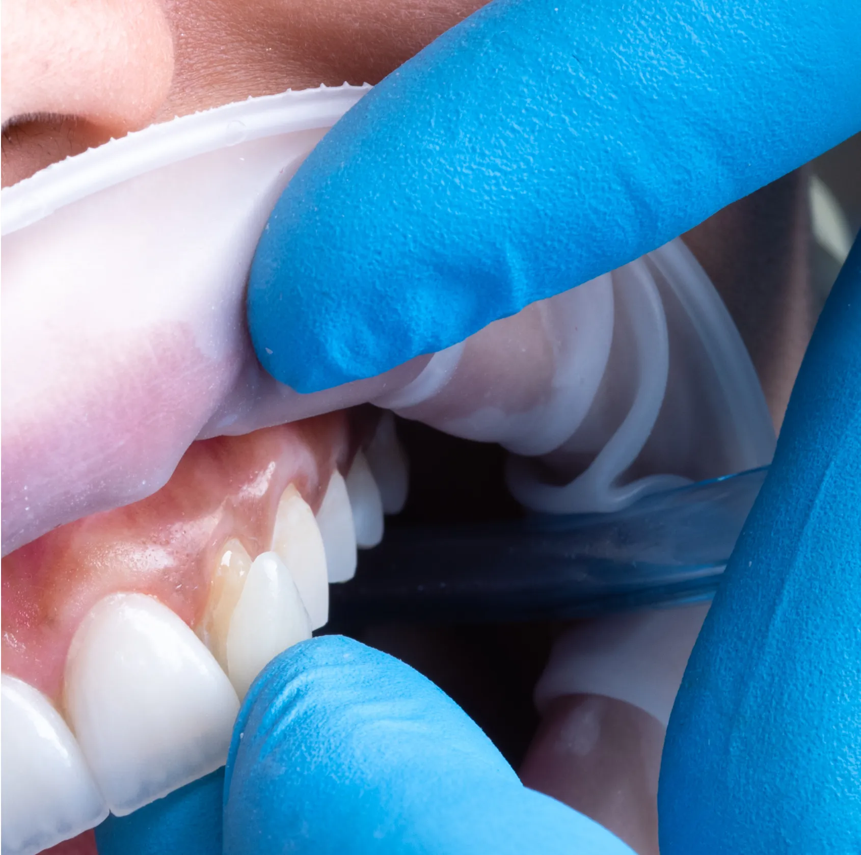 Dental professional wearing blue gloves holding a dental veneer near a patient's upper front teeth.