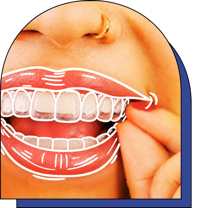 Woman adjusting Invisalign.