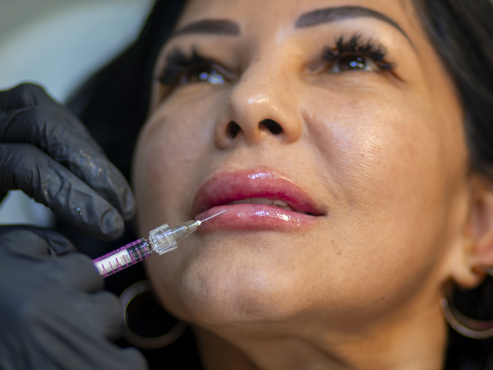 Close-up of a person receiving a cosmetic lip injection with a syringe.