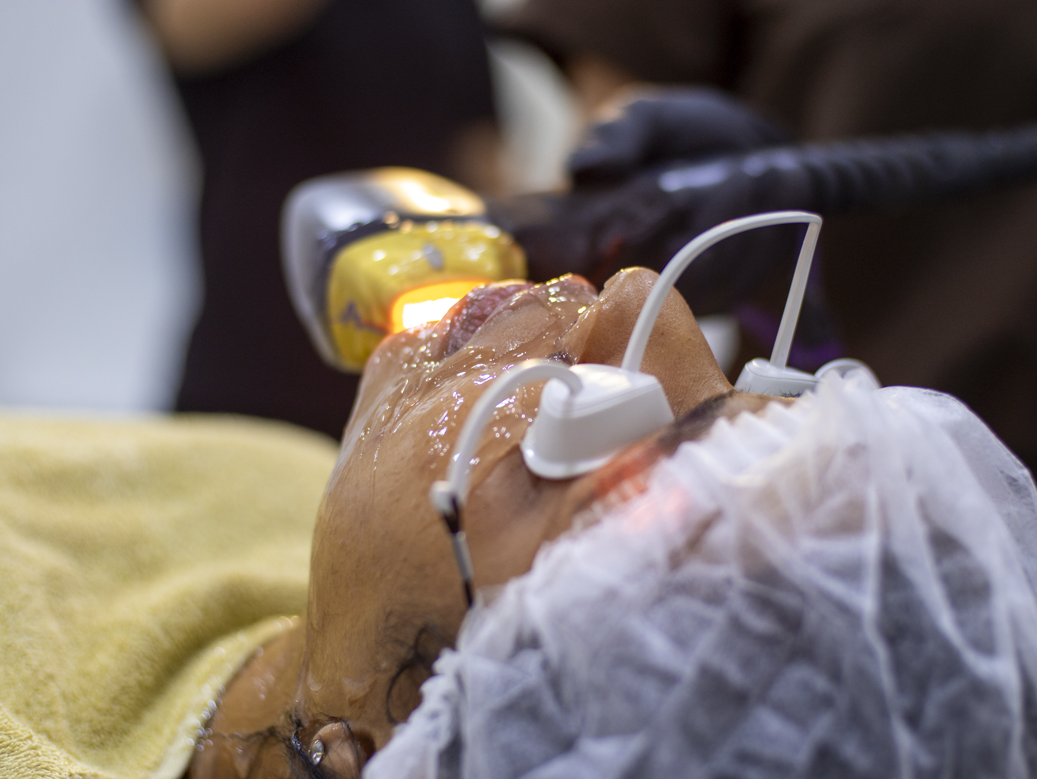 Close-up of a gloved hand performing a cosmetic treatment on a woman's thigh with a handheld device in a clinical setting.
